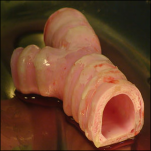 Première trachée artificielle, greffée le 9 Juin 2011