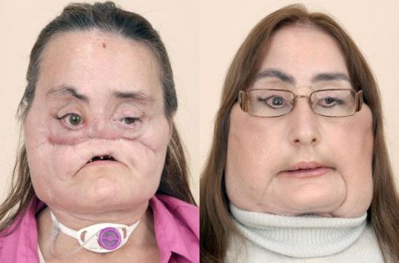 Connie Culp, première greffe totale du visage, USA, 2008